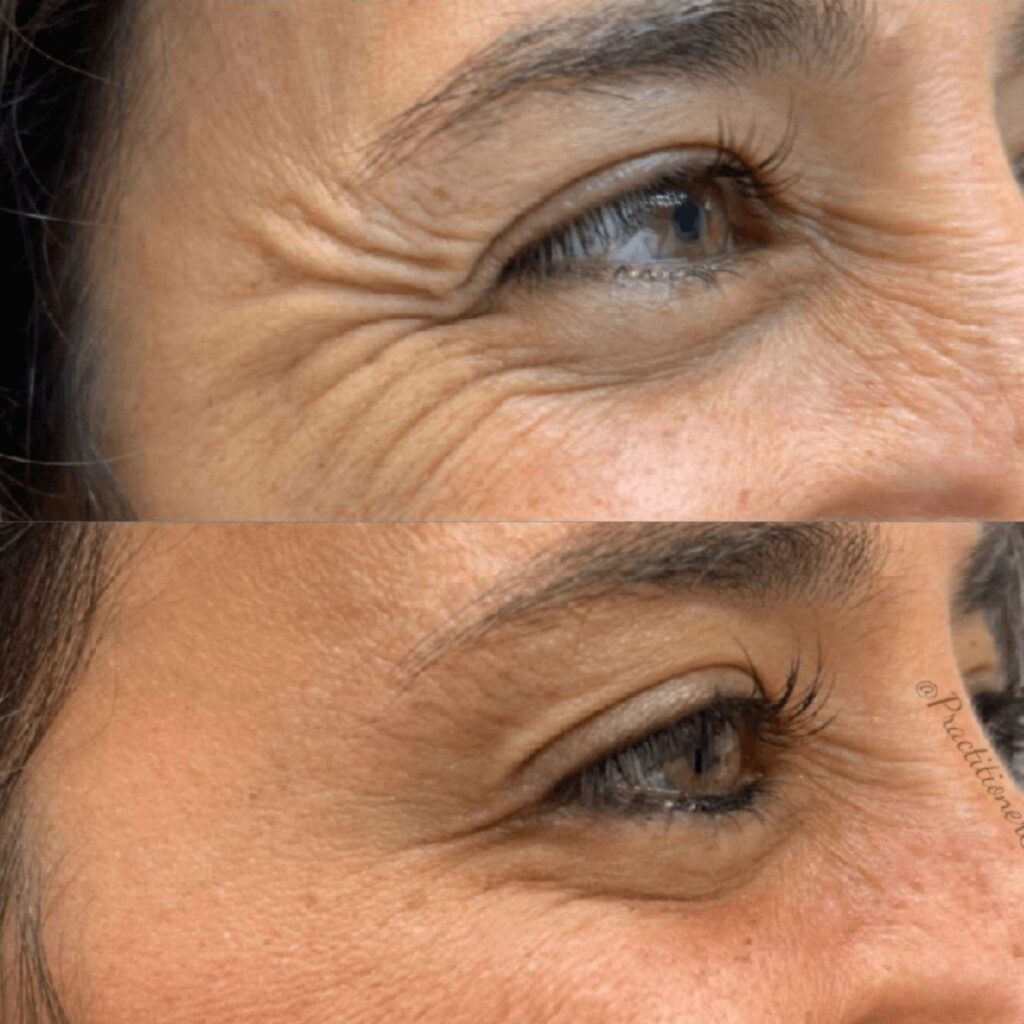 Ετών 40 & Botox / Πηγή: Pinterest.com
